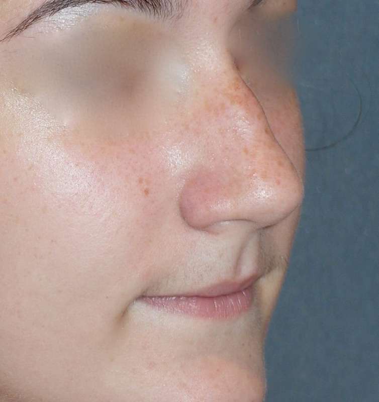Rhinoplasty Before & After Patient #787