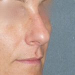 Rhinoplasty Before & After Patient #798