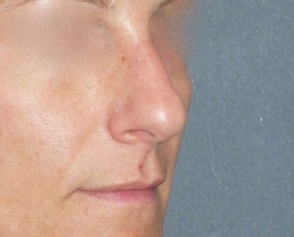 Rhinoplasty Before & After Patient #798