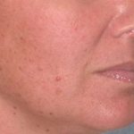 Juv&eacute;derm - Lips Before & After Patient #659