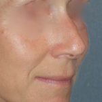 Rhinoplasty Before & After Patient #809