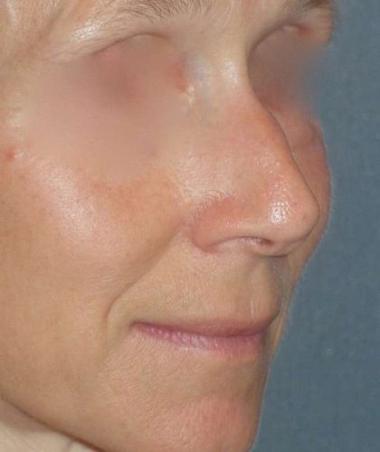 Rhinoplasty Before & After Patient #809