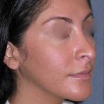 Rhinoplasty Before & After Patient #816