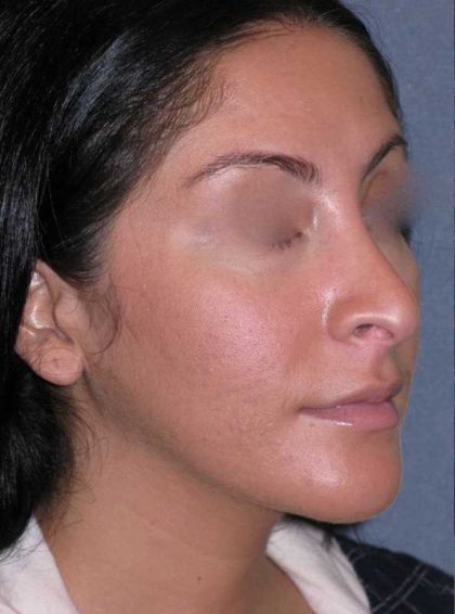 Rhinoplasty Before & After Patient #816