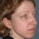 Rhinoplasty Before & After Patient #823