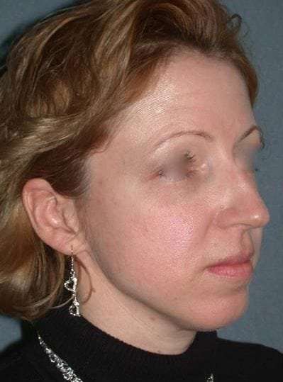 Rhinoplasty Before & After Patient #823