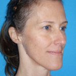 Rhinoplasty Before & After Patient #834