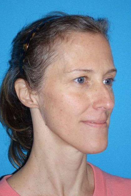Rhinoplasty Before & After Patient #834