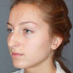 Rhinoplasty Before & After Patient #845