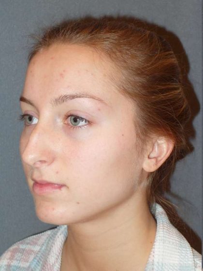 Rhinoplasty Before & After Patient #845