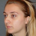 Rhinoplasty Before & After Patient #856