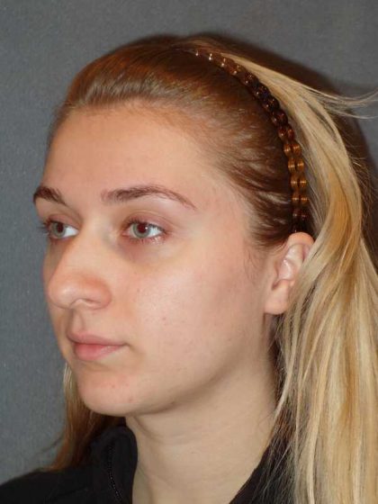 Rhinoplasty Before & After Patient #856