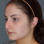 Rhinoplasty Before & After Patient #867
