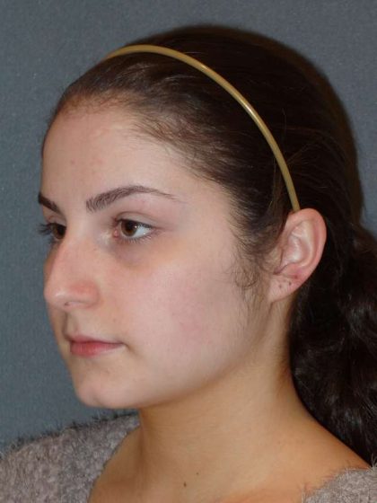 Rhinoplasty Before & After Patient #867