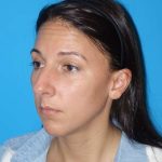 Rhinoplasty Before & After Patient #878