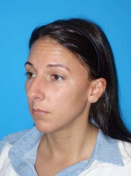 Rhinoplasty Before & After Patient #878