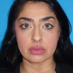 Rhinoplasty Before & After Patient #887