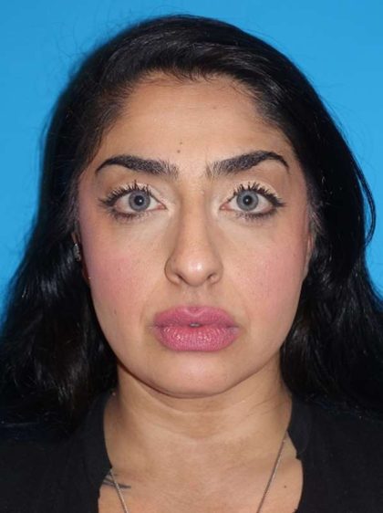 Rhinoplasty Before & After Patient #887