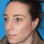 Rhinoplasty Before & After Patient #898
