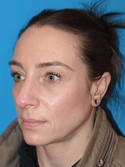 Rhinoplasty Before & After Patient #898