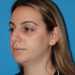 Rhinoplasty Before & After Patient #909
