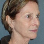 Deep Plane Lower Face & Neck Lift Before & After Patient #920