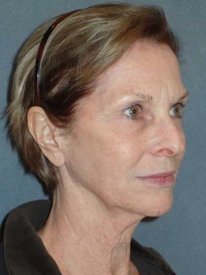 Deep Plane Lower Face & Neck Lift Before & After Patient #920
