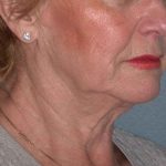 Deep Plane Lower Face & Neck Lift Before & After Patient #936