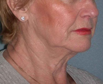 Deep Plane Lower Face & Neck Lift Before & After Patient #936