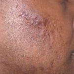 Fraxel Restore Acne Scarring Before & After Patient #682