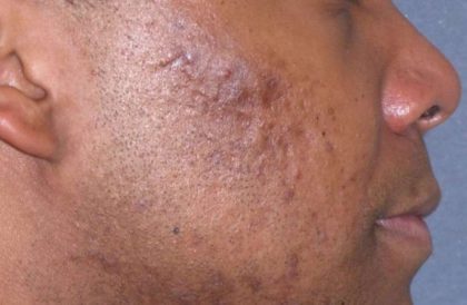 Fraxel Restore Acne Scarring Before & After Patient #682