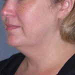 Deep Plane Lower Face & Neck Lift Before & After Patient #947