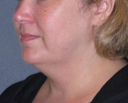 Deep Plane Lower Face & Neck Lift Before & After Patient #947