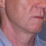 Deep Plane Mini Lift & Neck Lift Before & After Patient #965