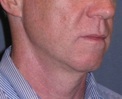 Deep Plane Mini Lift & Neck Lift Before & After Patient #965