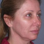 Deep Plane Mini Lift & Neck Lift Before & After Patient #981