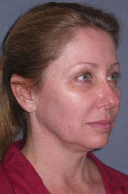 Deep Plane Mini Lift & Neck Lift Before & After Patient #981