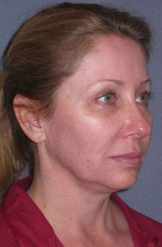 Deep Plane Mini Lift & Neck Lift Before & After Patient #981