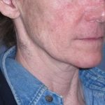 Deep Plane Mini Lift & Neck Lift Before & After Patient #988