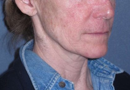 Deep Plane Mini Lift & Neck Lift Before & After Patient #988