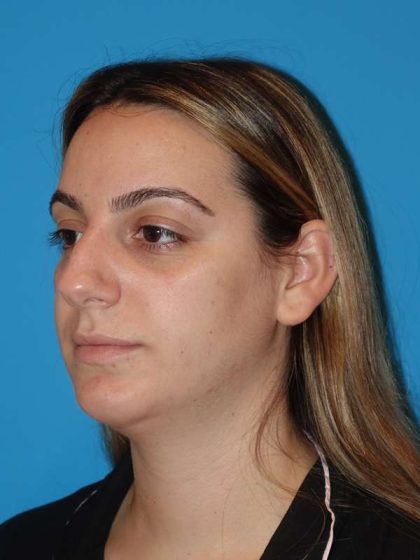 Neck Liposuction Before & After Patient #999