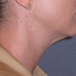 Neck Lift Before & After Patient #1007