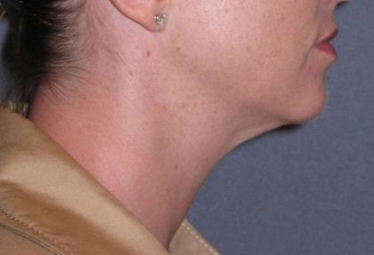 Neck Lift Before & After Patient #1007