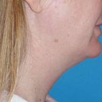 Neck Lift Before & After Patient #1018