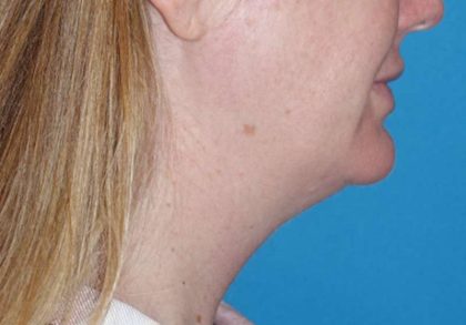 Neck Lift Before & After Patient #1018