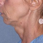 Deep Plane Mini Lift & Neck Lift Before & After Patient #1023