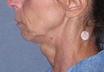 Deep Plane Mini Lift & Neck Lift Before & After Patient #1023