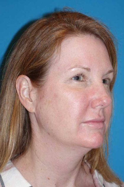 Morpheus8 Before & After Patient #693