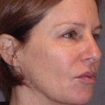 Deep Plane Mini Lift & Neck Lift Before & After Patient #1030
