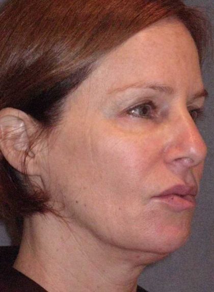 Deep Plane Mini Lift & Neck Lift Before & After Patient #1030